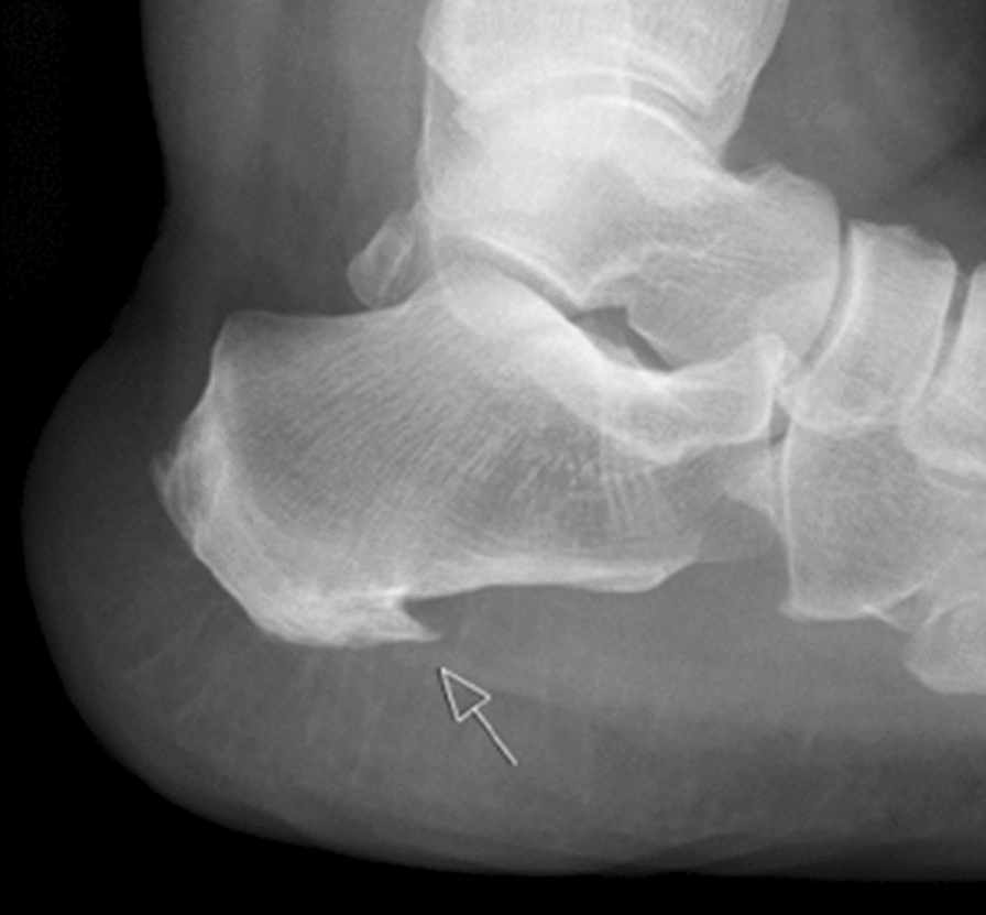 LDRT for painful plantar enthesophyte: a highly effective therapy with little side effects